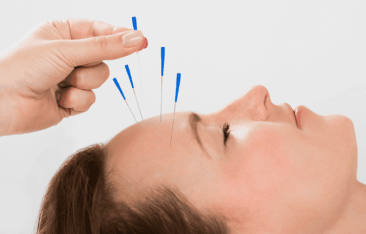 Điện mãng châm điều trị Suy nhược thần kinh (Kiệt vong, Thất miên, Đầu thống)